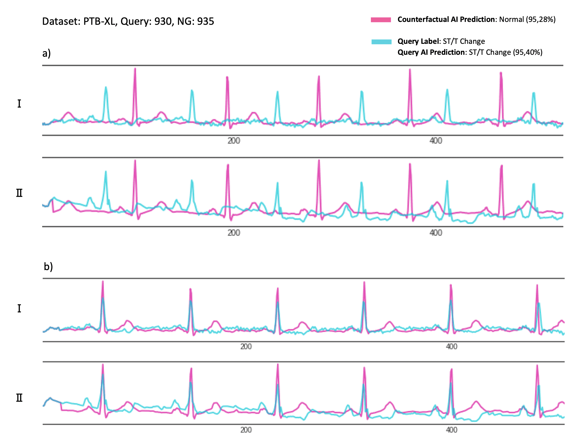 Two pairs of ECG traces. In the top pair the counterfactual's peaks fall between the original's peaks; in the bottom pair they line up.